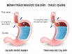 Làm sao để chửa khỏi trào ngược dạ dày? Tìm hiểu ngay để biết